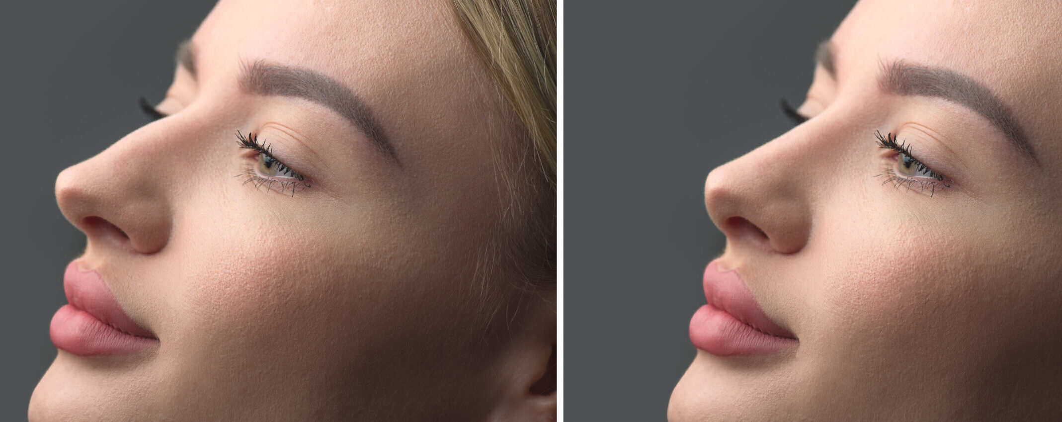 Nose Before and after plastic surgery. Rhinoplasty. Crooked nose correcting. Young woman profile portrait, over grey background. Beauty female, model girl face close-up. Aesthetic medicine