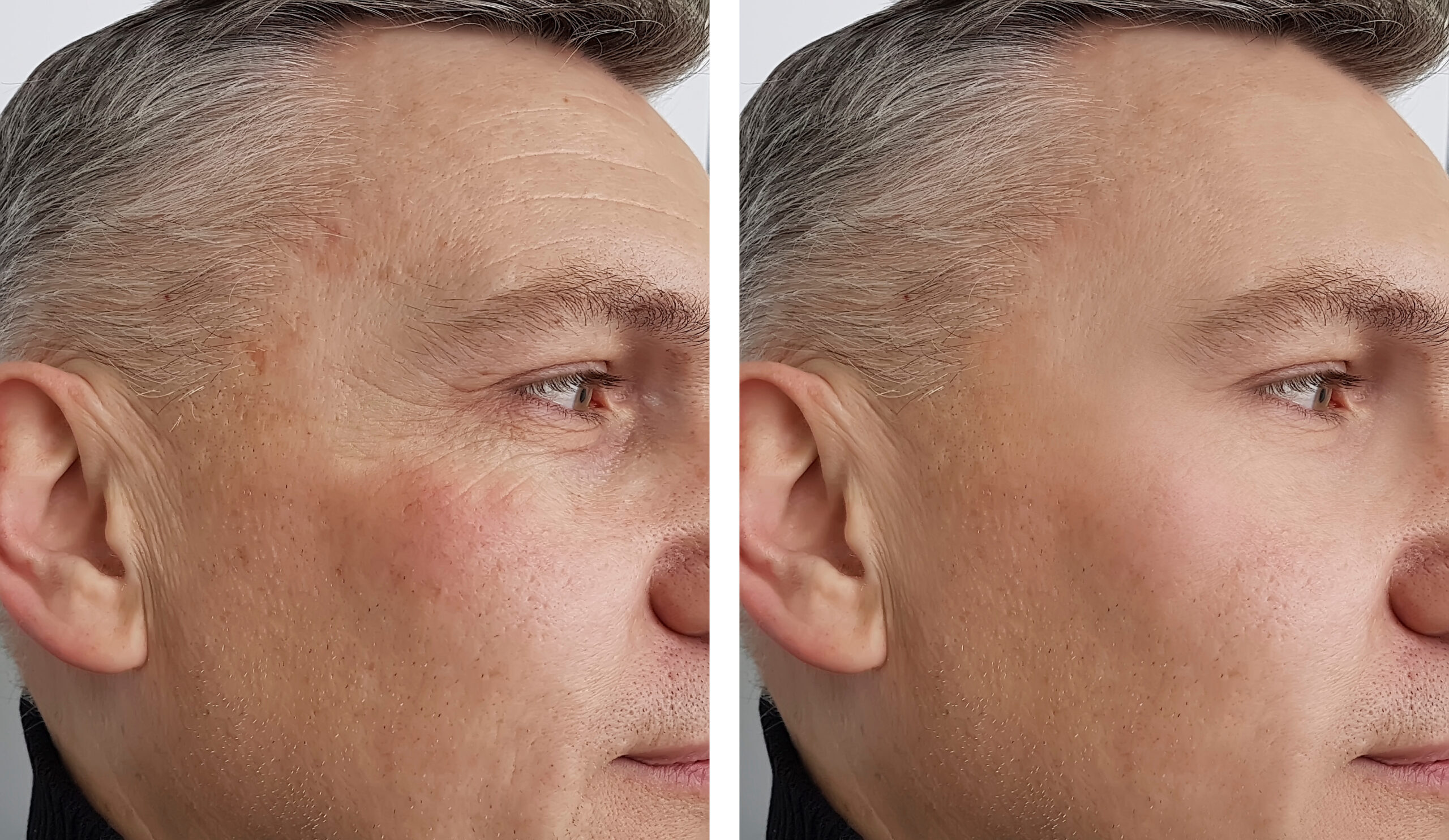 face man man wrinkles before and after